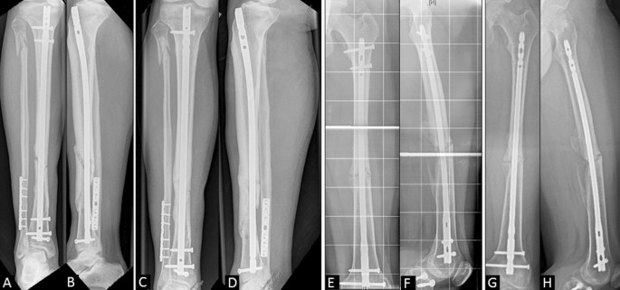 Addition of shock wave therapy to nail dynamization increases the chance of  long-bone non-union healing | Journal of Orthopaedics and Traumatology |  Full Text