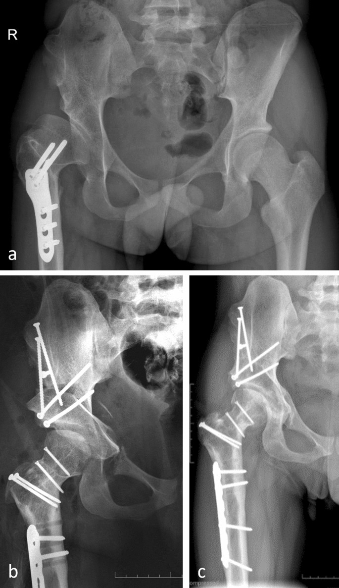 Bernese periacetabular osteotomy (PAO): from its local inception to its  worldwide adoption | Journal of Orthopaedics and Traumatology | Full Text