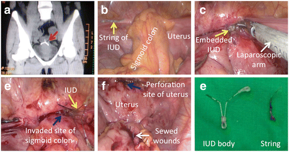 Clinical characteristic and intraoperative findings of perforation patients in using of intrauterine devices (IUDs) | Gynecological Surgery | Full Text