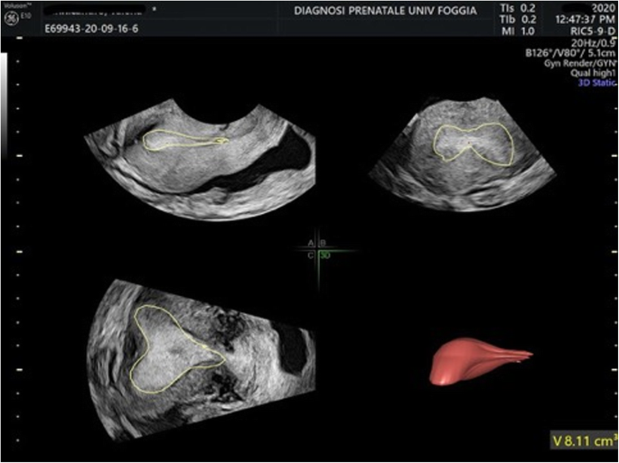 The use of hysteroscopic metroplasty with diode laser to increase  endometrial volume in women with septate uterus: preliminary results |  Gynecological Surgery | Full Text