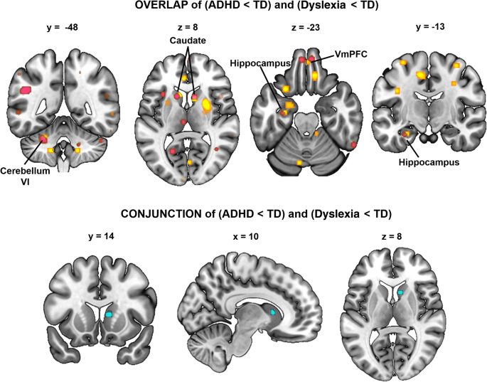 Are there shared neural correlates between dyslexia and ADHD? A ...