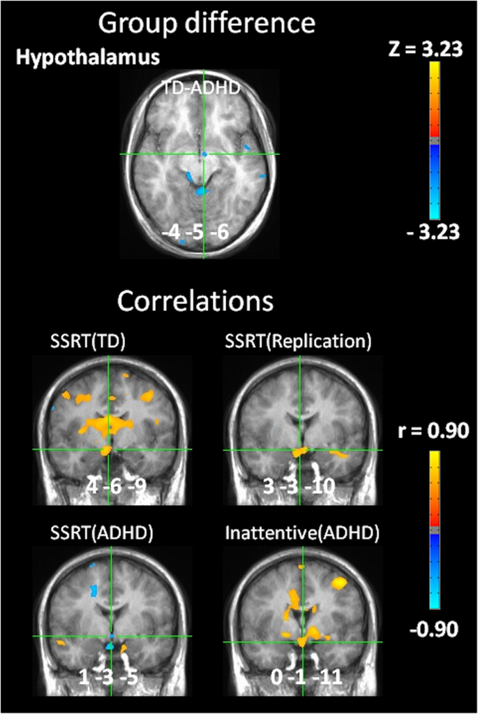 BOLD differences normally attributed to inhibitory control predict  symptoms, not task-directed inhibitory control in ADHD | SpringerLink