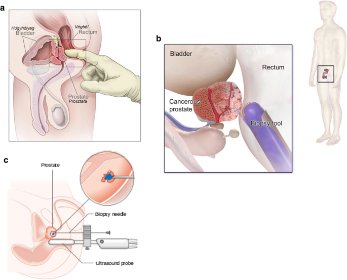 Hyperplasia 2 St Prosztata