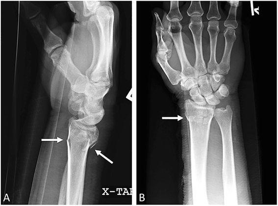 What's in a name? Upper extremity fracture eponyms (Part 1) | International  Journal of Emergency Medicine | Full Text
