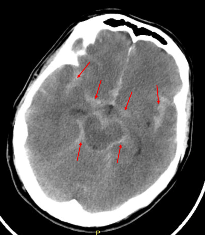 Subarachnoid Hemorrhage (SAH): Symptoms & Treatment