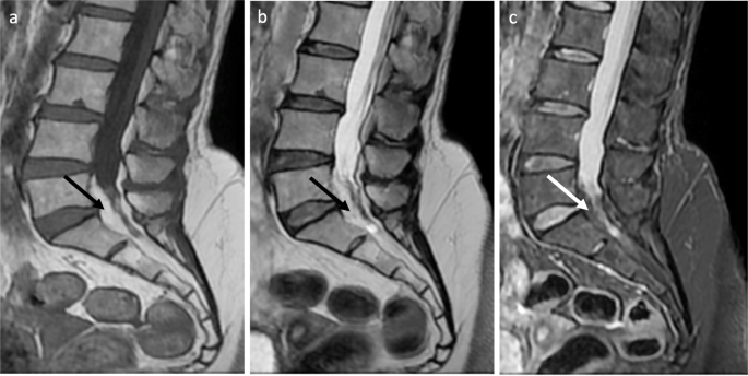 Spinal epidural lipomatosis | International Journal of Emergency Medicine |  Full Text