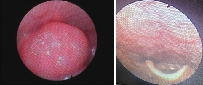 Vaping-induced acute epiglottitis: a case report | International Journal of  Emergency Medicine