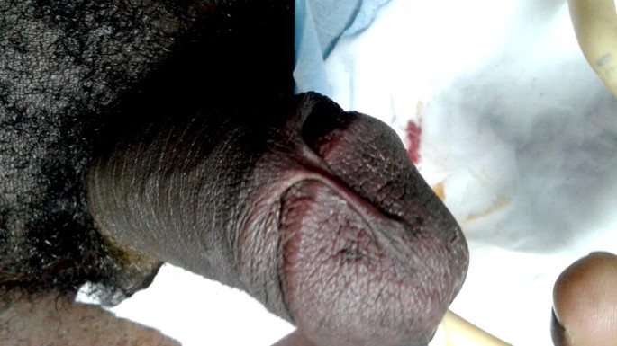 Specifiek Uitreiken faillissement Dorsal penile frenulum a rare congenital abnormality | African Journal of  Urology | Full Text
