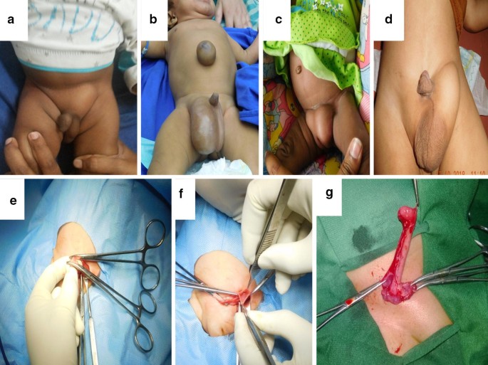 The demographic profile and the management of infantile inguinal hernia: a  3-year's review | African Journal of Urology | Full Text