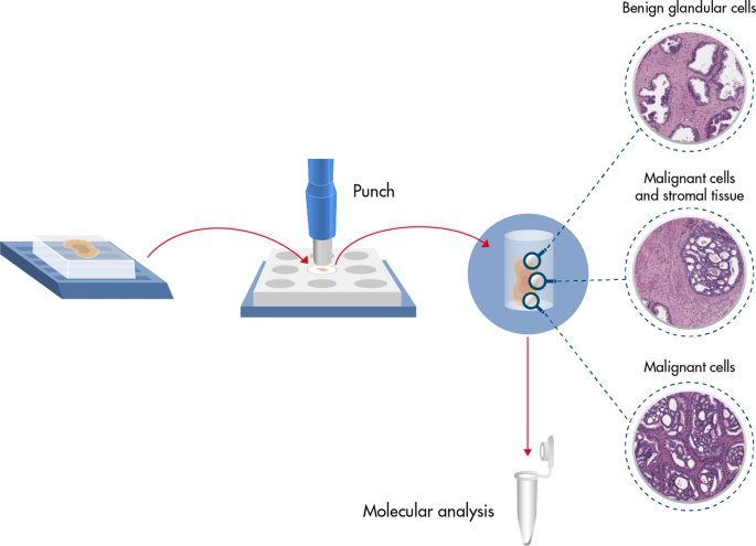 Why not to use punch biopsies in formalin-fixed paraffin-embedded samples  of prostate cancer tissue for DNA and RNA extraction? | African Journal of  Urology | Full Text