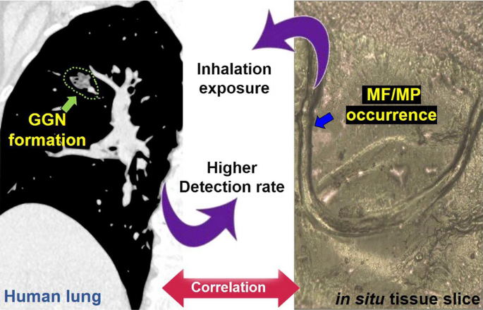 An emerging role of microplastics in the etiology of lung ground glass  nodules | Environmental Sciences Europe | Full Text