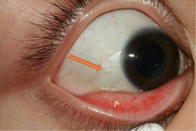 Therapy Resistant Dry Itchy Eyes Journal Of Ophthalmic