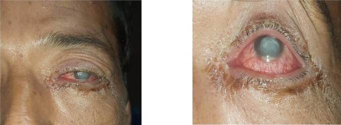 Úlcera corneal tras picadura de alacrán alrededor del ojo: reporte de un caso  Revista de oftalmitis e infección