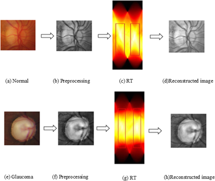 A Novel Glaucomatous Representation Method Based On Radon And Wavelet Transform Bmc Bioinformatics Full Text