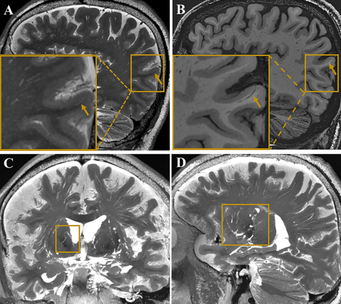 Visualization of perivascular spaces in the human brain with 5-T ...