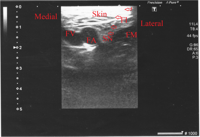 sciatic nerve block anterior approach