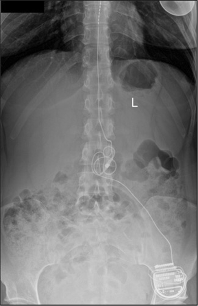 🥇 Atlanta Spinal Cord Stimulation SCS