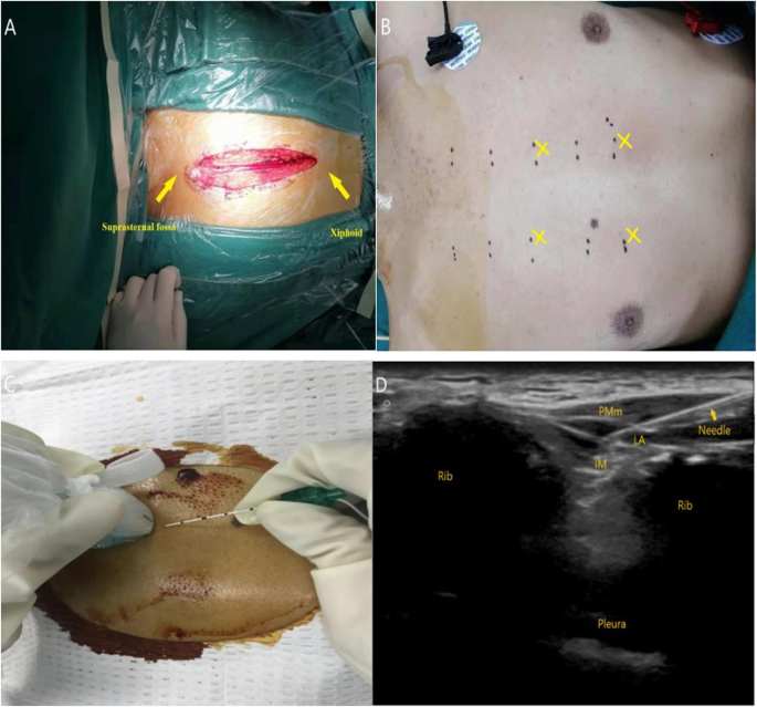 Ultrasound Guided Parasternal Intercostal Nerve Block For Postoperative Analgesia In Mediastinal Mass Resection By Median Sternotomy A Randomized Double Blind Placebo Controlled Trial Springerlink