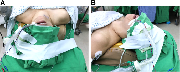 Vocal cord granuloma after transoral thyroidectomy using oral endotracheal  intubation: two case reports | BMC Anesthesiology | Full Text