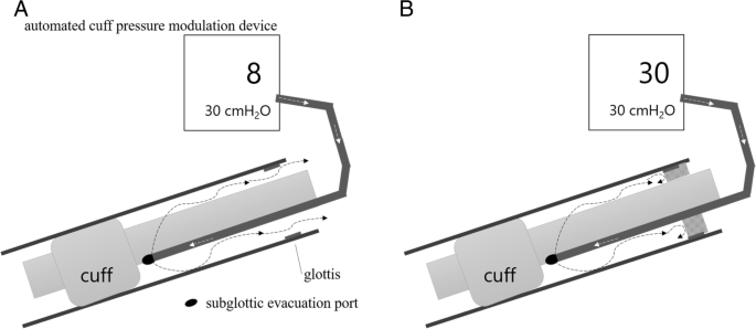 A novel technique for assessment of post-extubation airway obstruction can  successfully replace the conventional cuff leak test: a pilot study | BMC  Anesthesiology | Full Text