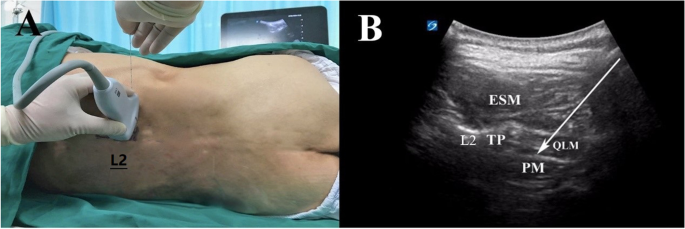 Anterior Quadratus Lumborum block area comparison in the three different  volumes of Ropivacaine: a double-blind, randomized controlled trial in  healthy volunteers | BMC Anesthesiology | Full Text