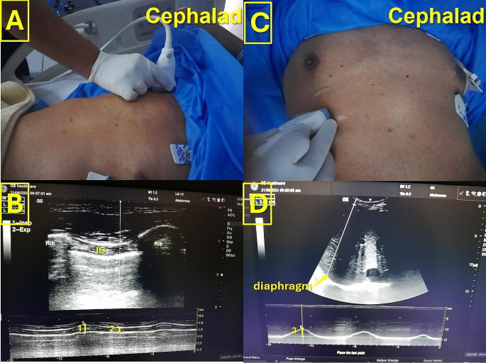 diaphragmatic excursion treatment figure 1