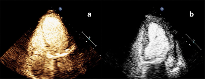 Myocardial contrast echocardiography in the diagnosis of postoperative  takotsubo myocardiopathy: case report and literature review | BMC  Cardiovascular Disorders | Full Text