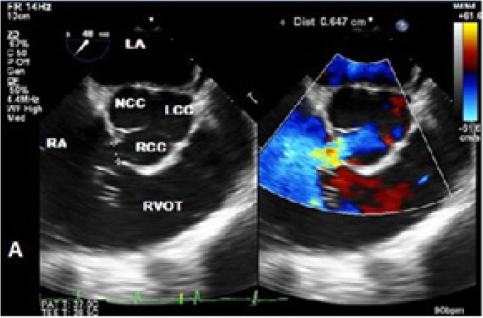 Acute rupture of a sinus of Valsalva aneurysm into the right atrium: a case  report and a narrative review | BMC Cardiovascular Disorders | Full Text