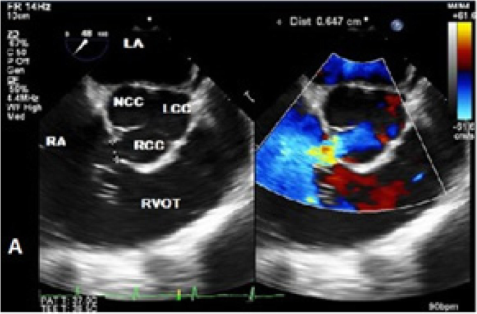 Acute Rupture Of A Sinus Of Valsalva Aneurysm Into The Right Atrium A Case Report And A Narrative Review Bmc Cardiovascular Disorders Full Text