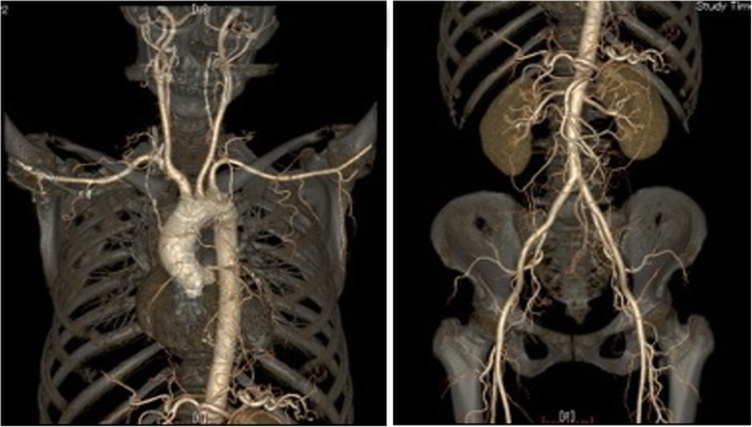 Intravascular ultrasound imaging of isolated and non aorto-ostial ..., حجم الصورة 685x389