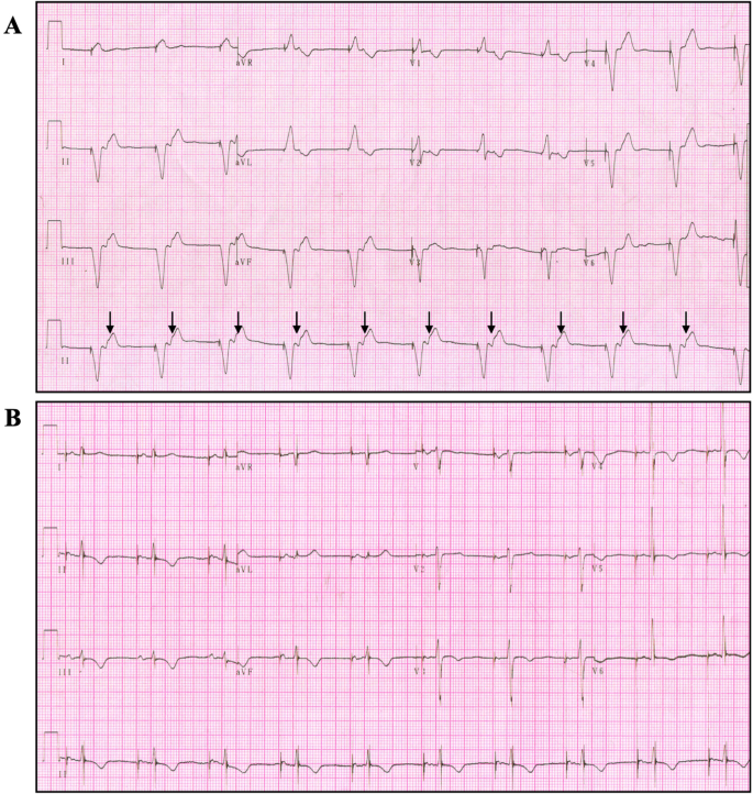 woede rooster Gelijkenis Adverse clinical events caused by pacemaker battery depletion: two case  reports | BMC Cardiovascular Disorders | Full Text