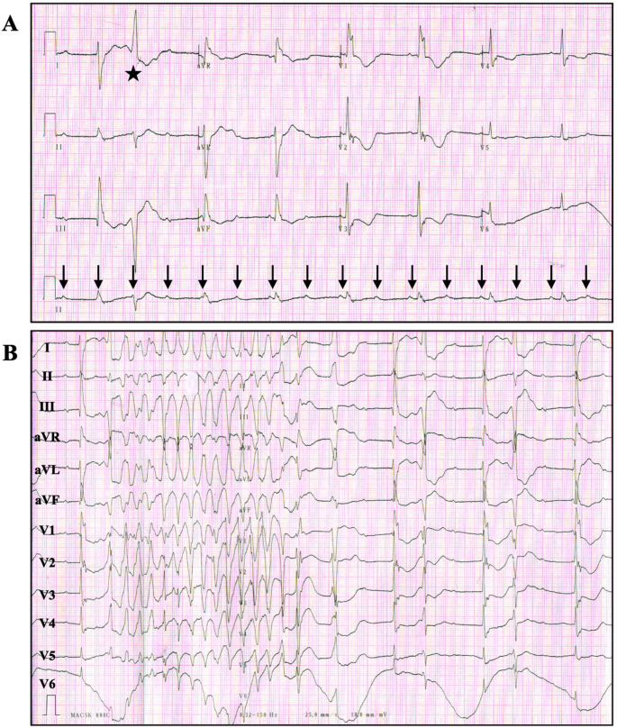 Adverse clinical events caused by pacemaker battery depletion: two case  reports | BMC Cardiovascular Disorders | Full Text