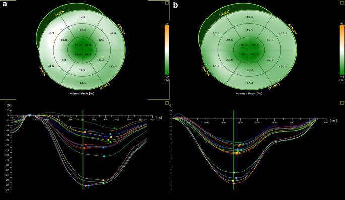 Three-dimensional Speckle Tracking Echocardiography in Light Chain Cardiac  Amyloidosis: Examination of Left and Right Ventricular Myocardial Mechanics  Parameters