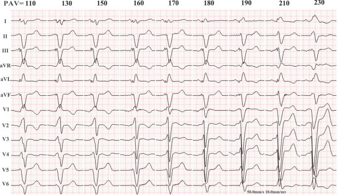 Optimization of the AV delay in a patient with complete AV block