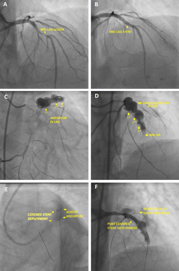 Case series of coronary artery aneurysms after Everolimus eluting stent  implantation and comparison with Sirolimus eluting stents | BMC  Cardiovascular Disorders | Full Text
