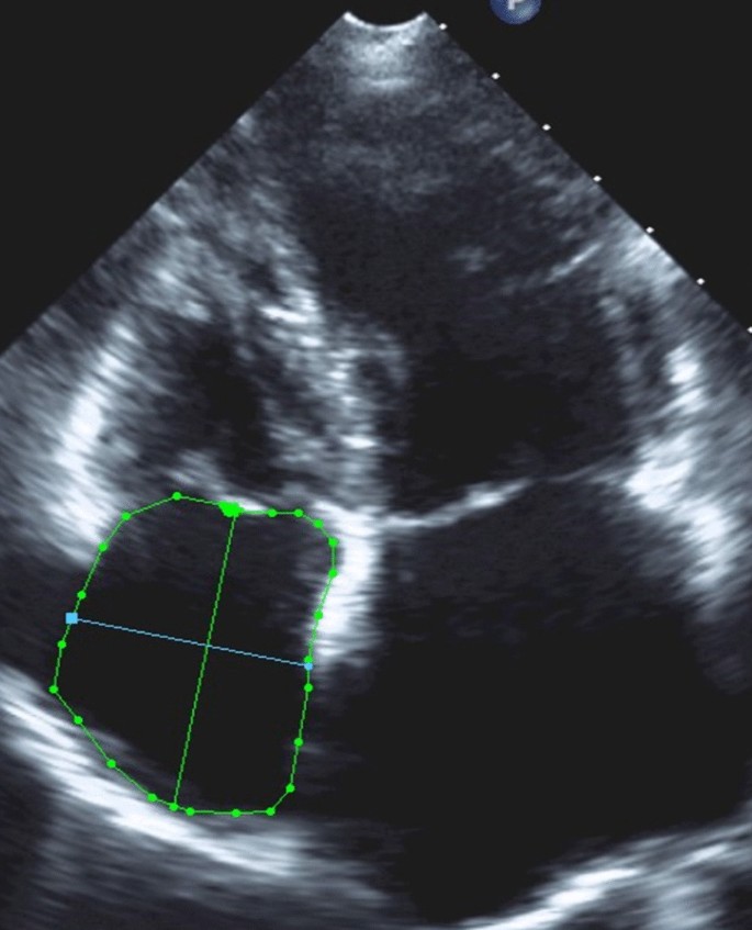 Prognostic Utility of Echocardiographic Atrial and Ventricular Strain  Imaging in Patients With Cardiac Amyloidosis