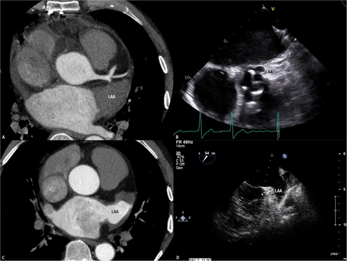 Patch Closure The effect of the pericardial patching exclusion technique for left ...