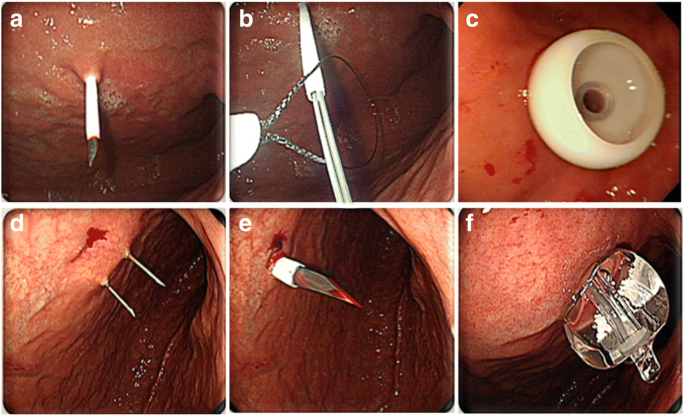 Risk factors for complications and mortality of percutaneous endoscopic gastrostomy  insertion | BMC Gastroenterology | Full Text