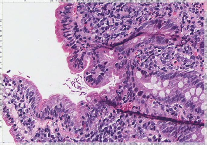 Giardia duodenal biopsy
