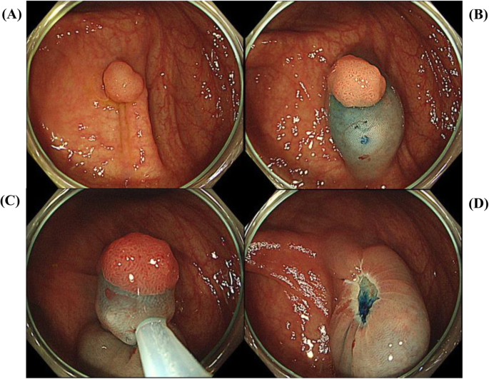 Colorectal Endoscopic Mucosal Resection With Submucosal Injection Of Epinephrine Versus Hypertonic Saline In Patients Taking Antithrombotic Agents Propensity Score Matching Analysis Bmc Gastroenterology Full Text