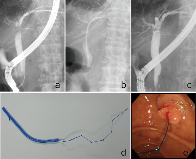 ercp stent