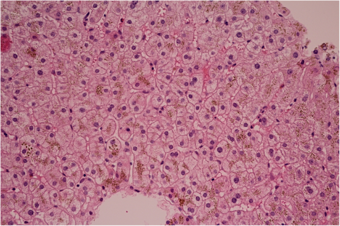 New mutation of the ceruloplasmin gene in the case of a neurologically  asymptomatic patient with microcytic anaemia, obesity and supposed Wilson's  disease | BMC Gastroenterology | Full Text