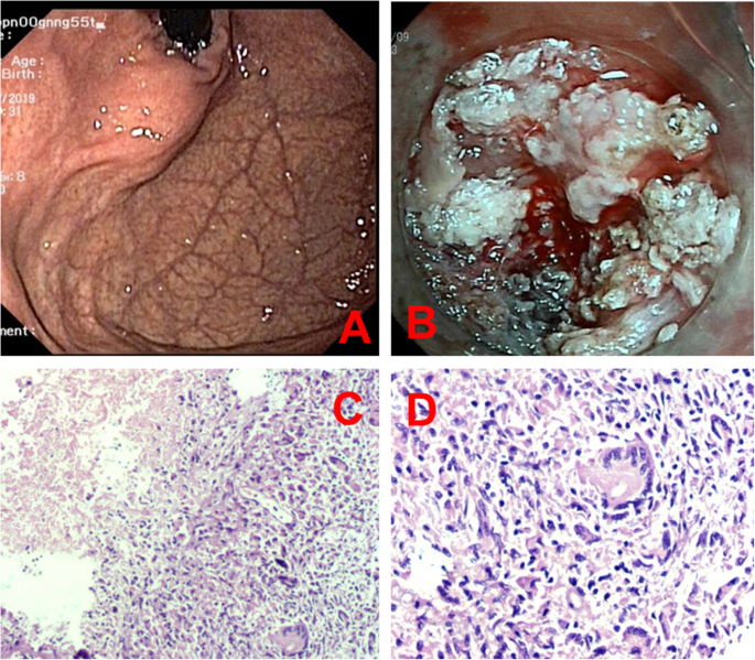Primary Isolated Asymptomatic Gastric Tuberculosis Of The Cardia