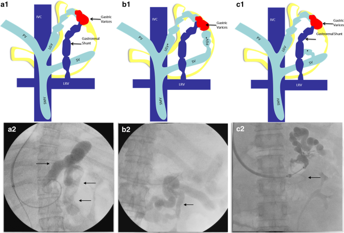 splenorenal shunt embolization