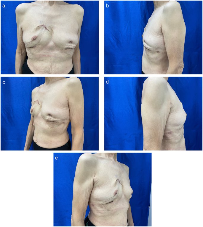 Dr. Alexander & Co. - Breast augmentation done with silicone gel