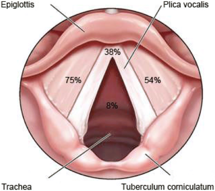 Human papilloma larynx Papilloma of the larynx - Squamous papilloma larynx