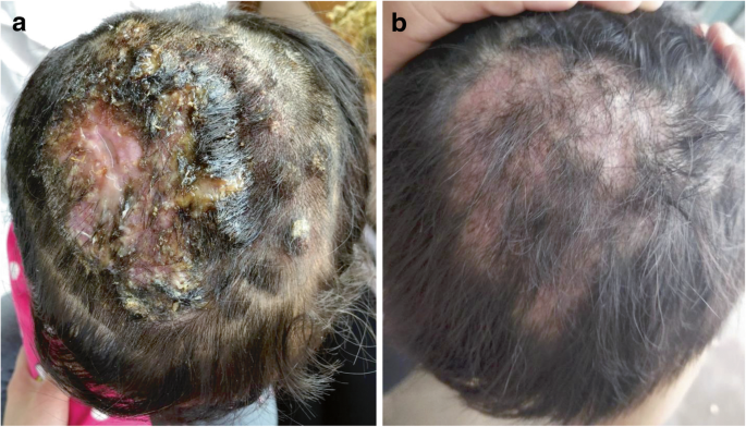 The first case report of kerion-type scalp mycosis caused by Aspergillus  protuberus | BMC Infectious Diseases | Full Text