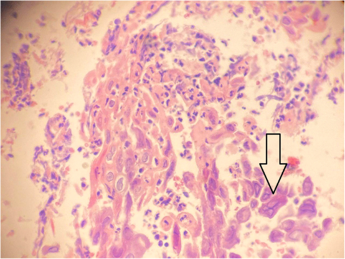 Epigastric Pain Associated With Herpes Esophagitis Case Report Bmc Infectious Diseases Full Text