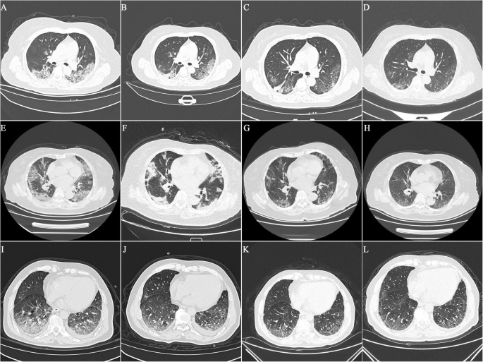 Maximum Chest Ct Score Is Associated With Progression To Severe Illness In Patients With Covid 19 A Retrospective Study From Wuhan China Bmc Infectious Diseases Full Text