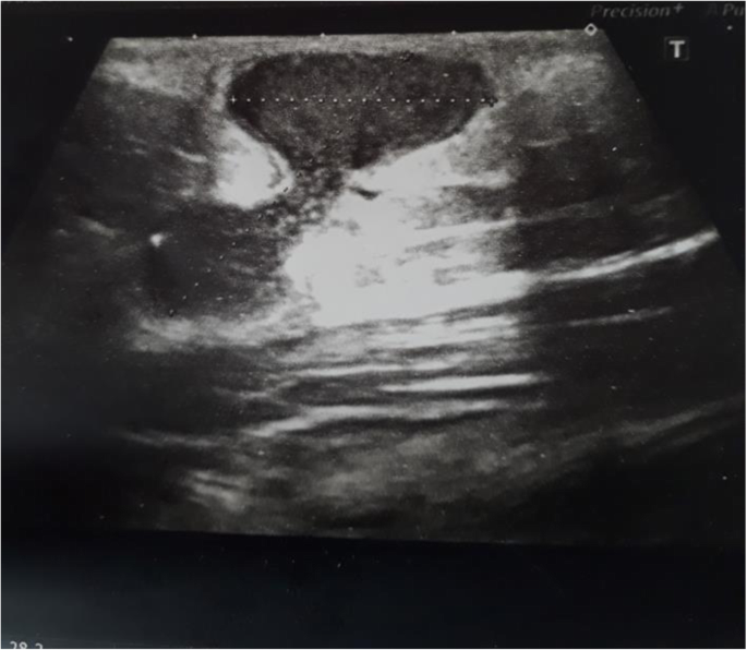 A Case Of Recurrent Sterile Abscesses Following Tetanus Diphtheria Vaccination Treated With Corticosteroids Bmc Infectious Diseases Full Text